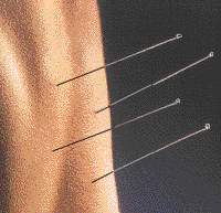 Acupunctuur